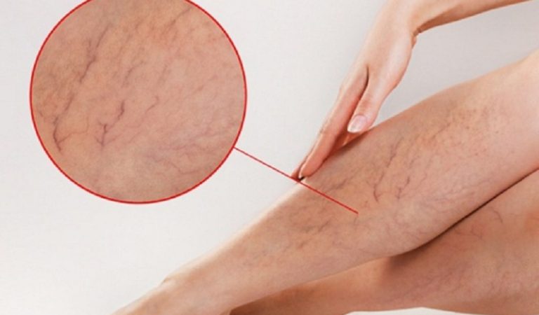 Tired of Vein Pain? Try These Lemon Varicose Vein Remedies to Feel Better