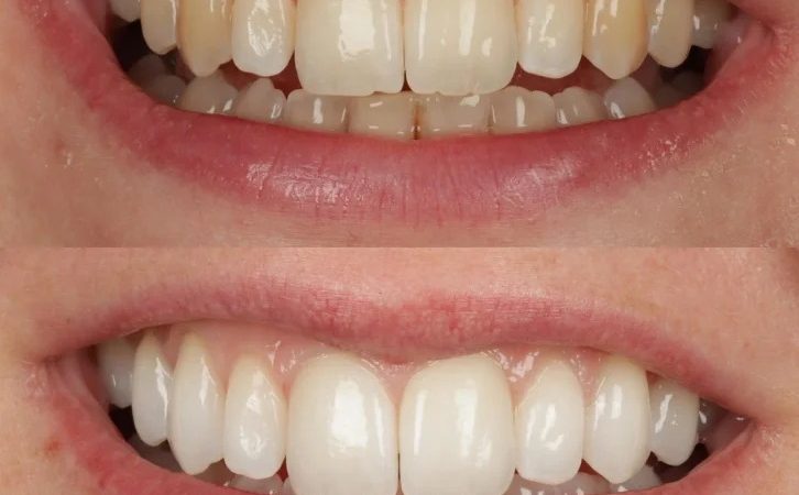 Whiten Teeth with Rice and Brighten Your Smile Naturally