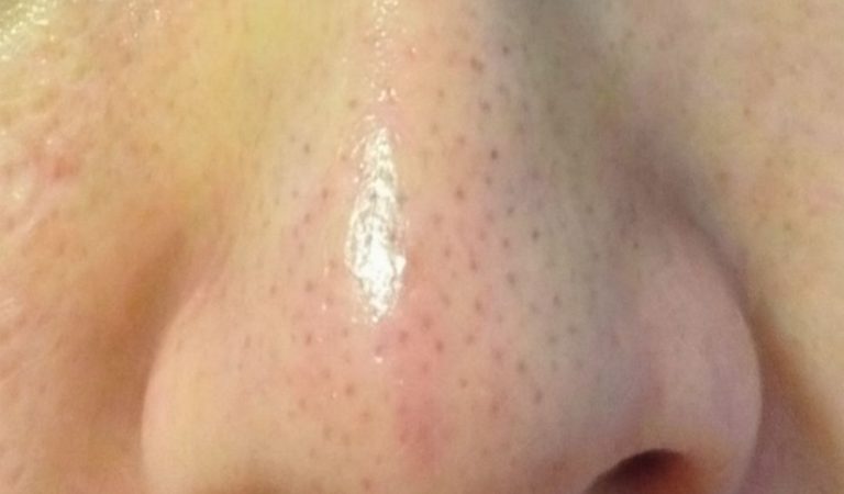 What Are Sebaceous Filaments and Why Are They on Your Face? What Are Sebaceous Filaments and Why Are They on Your Face?