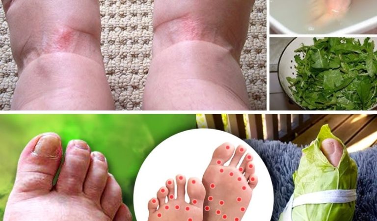 8 Natural Remedies to Soothe Swollen Legs and Joint Inflammation 8 Natural Remedies to Soothe Swollen Legs and Joint Inflammation